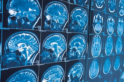 Twentse technologie moet genezing hersenkanker en andere hersenziekten helpen mogelijk maken