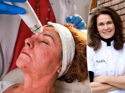 Microneedling: how tiny needles combat skin aging