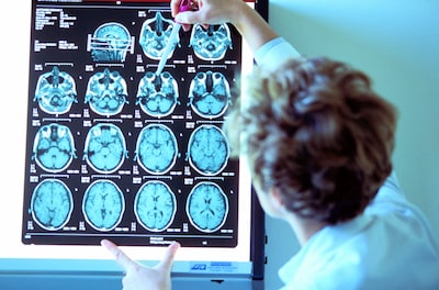 Neurologen kunnen meer doen om een brein te redden, maar er zijn er veel te weinig