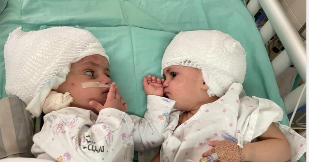 Medisch wonder: Siamese tweeling door zeldzame operatie van elkaar ...