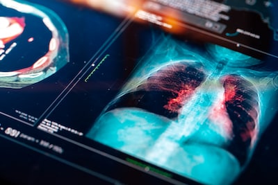 Cancer appears cured but returns: why the disease is often difficult to treat