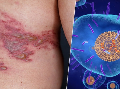 Pain expert on shingles: One of the most painful conditions you can have