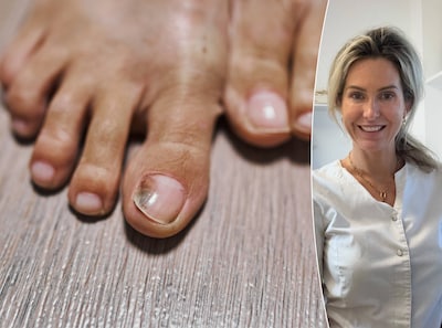 Wat is een schimmelnagel en hoe kom je ervan af? Medisch pedicure legt het uit