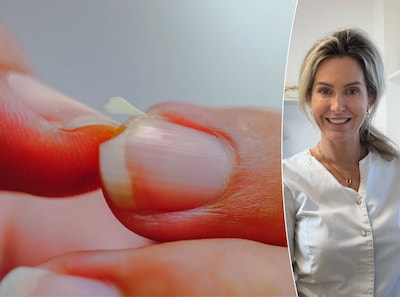 Heb je dunne nagels die snel scheuren? Dit kan helpen volgens medisch pedicure