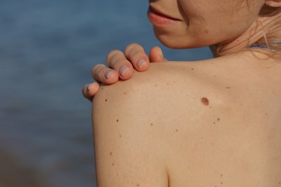 Strange mole? Do the ABCDE check: ‘Benign spots are usually uniform’