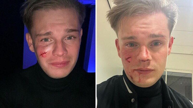 Dennis Schouten doet aangifte na steekpartij, politie zoekt getuigen | Show  | AD.nl