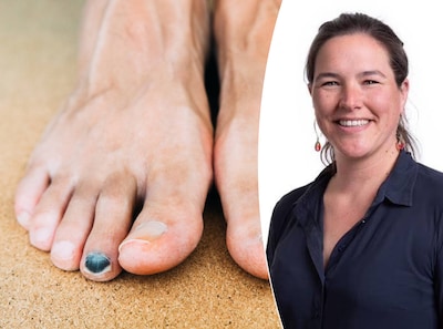 Painful, black toenails after running: this is 'runner's toe' and how you can prevent it