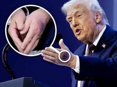 davos-switzerland-january-22-a-bruise-can-be-seen-on-the-back-of-u-s-president-donald-trump-s-left-hand-during-a-signing-ceremony-for-the-aboard-of-peacea-at-the-world-economic-forum-wef-on-january-22-2026-in-davos-switzerland-the-us-backed-aboard-of-peacea-is-intended-to-administer-the-fragile-ceasefire-in-the-gaza-strip-after-the-war-between-israel-and-hamas-the-final-makeup-of-the-board-has-not-been-confirmed-photo-by-chip-somodevilla-getty-images