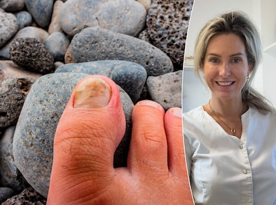 Hoe ontstaan kalknagels en wat helpt? Medisch pedicure legt uit